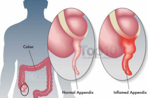 appendicitis-1000-w900-h600