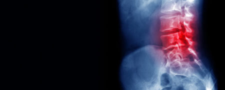 ۵ نوع کمردردی که به مشکلات جدی درباره سلامت شما اشاره دارند