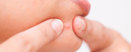 آنچه باید در مورد «آکنه های هورمونی» و روش های درمان آنها بدانید