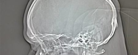 بسیار عجیب ولی واقعی؛ افرادی با مصدومیت های شدید که متوجه آن نشده بودند