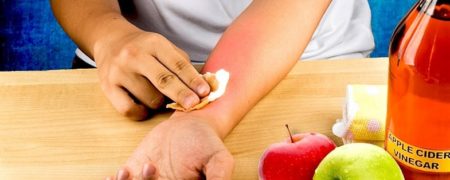 با ۱۱ راهکار غیرمعمول خانگی برای درمان آفتاب سوختگی آشنا شوید