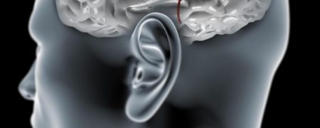 با «آنوریسم مغزی»، نشانه ها و دلایل ابتلا به آن آشنا شوید