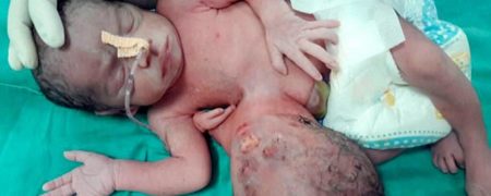 به دنیا آمدن نوزادی عجیب الخلقه با یک سر اضافه در کشور هند
