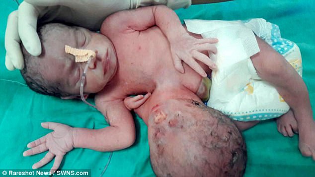 به دنیا آمدن نوزادی عجیب الخلقه با یک سر اضافه در کشور هند