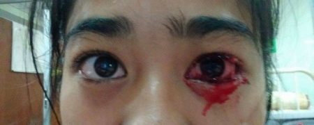 بیماری عجیب؛ دختری که به جای عرق از چشم ها، گوش و بینیش خون خارج می شود [تماشا کنید]