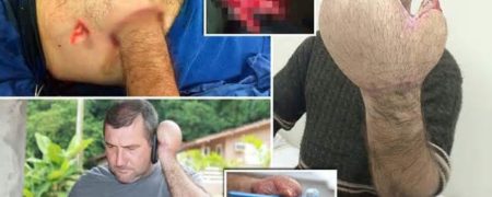 مردی که دستش در شکمش دوخته شده بود، در حال درمان است [تماشا کنید]