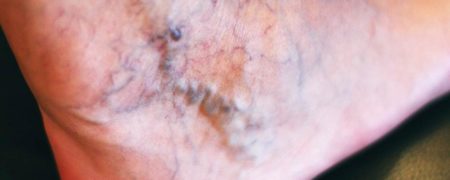 ۱۲ نکته مهم در مورد «واریس» که حتما باید از آنها آگاه باشید