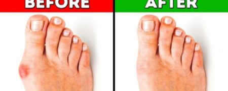 ۴ راهکار موثر برای برطرف کردن پینه شست پا و حفظ سلامت آن