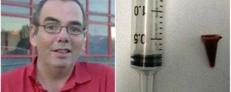 خارج کردن اسباب بازی مخروطی از ریه یک مرد بریتانیایی پس از ۴۰ سال