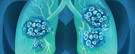 ۷ دلیل سرطان ریه در افراد غیرسیگاری و راه های جلوگیری از ابتلا به آن