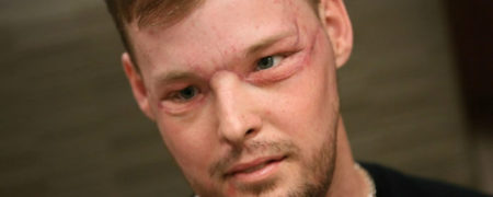 اولین نگاه در آینه بعد از یک دهه به دنبال جراحی صورت ۵۶ ساعته [تماشا کنید]