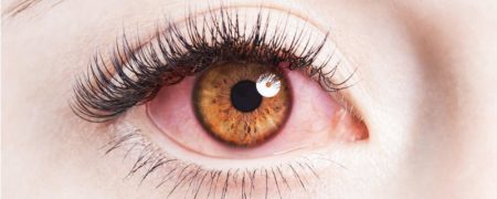 چرا چشم ها قرمز می شوند و چگونه می توان آن ها را درمان کرد؟