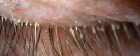 کلونی بیش از یکصد «مایت» در مژه های زنی که ۵ سال روبالشتی خود را نشسته بود