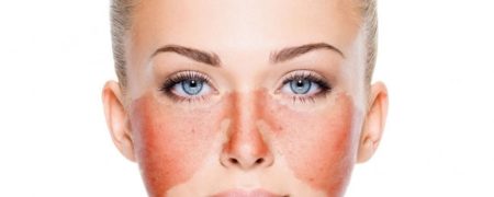 ۱۱ بیماری پوستی معمول که از وجود مشکل در بدنتان خبر می دهند