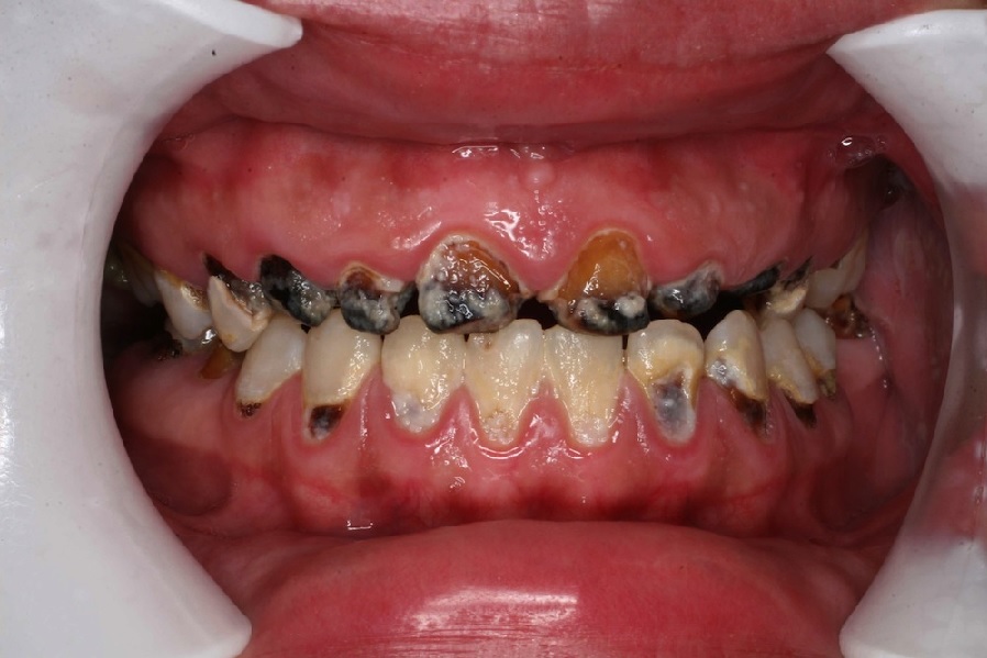 ۳۰۰ میلیون دندان پوسیده در دهان ایرانیان؛ مضرات دندان پوسیده چیست؟