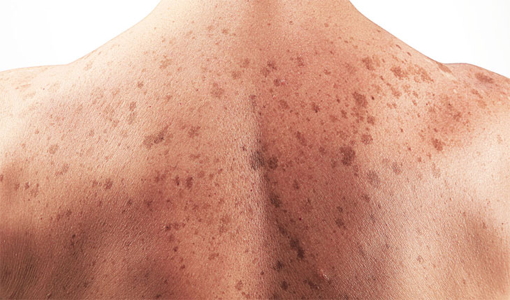 ۸ نقطه در بدن که علایم واضح سرطان پوست را در خود نشان خواهند داد