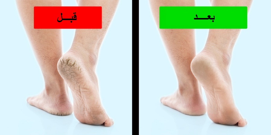 چند روش ساده و طبیعی برای داشتن پاهایی زیبا و سالم