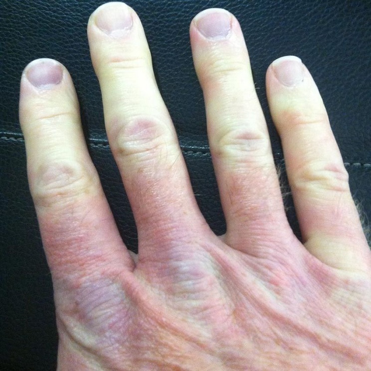 7_Multicolor_Raynaud-s_Right_Hand_GH_content_850px.jpg