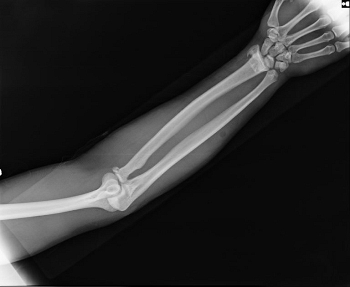 Переломы скелета. Перелом лучевой кости рентген. Кости предплечья рентген норма. Рентген лучезапястный сустав перелом лучевой кости. Перелом локтевого рентген.