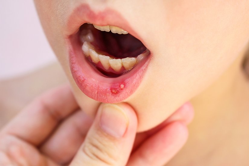 راهنمای کامل انواع بیماری های دهان و حلق؛ از گلو درد و زخم های آفتی تا سرطان حنجره