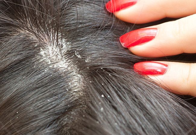 11 استفاده غیرمعمول از قرص آسپرین؛ از درمان شوره سر و موهای زیر پوستی تا رفع زنگ‌زدگی