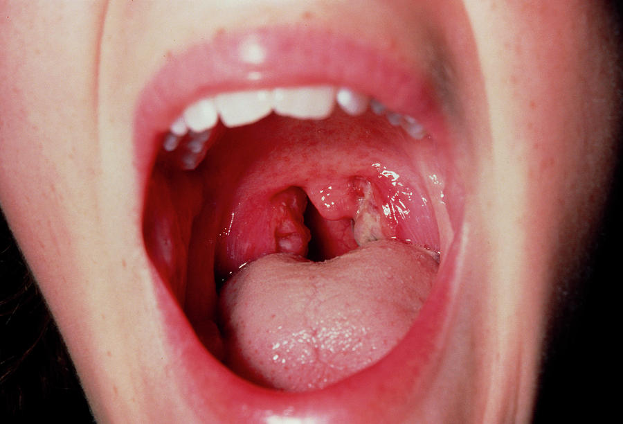 بیماری های دهان و حلق