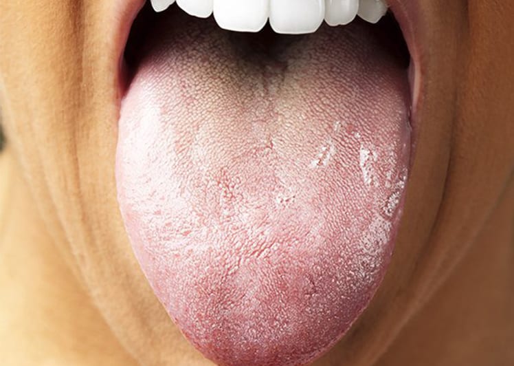 علت سفیدی زبان چیست و چطور می توان آن را درمان کرد؟