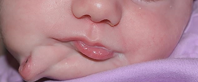 تولد نوزادی با دو دهان کامل در آمریکا بر اثر یک اختلال نادر