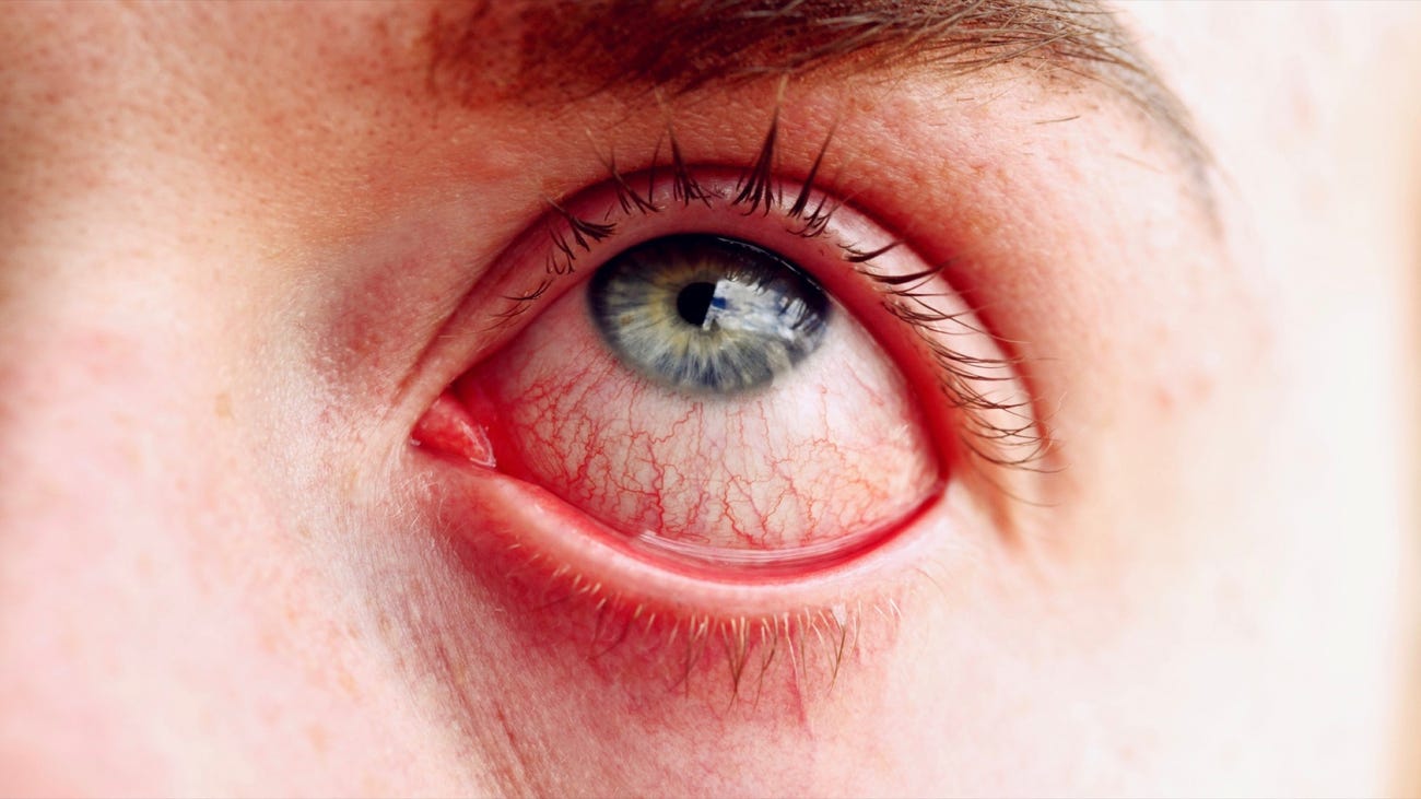 درمان قرمزی چشم با سه روش ساده خانگی