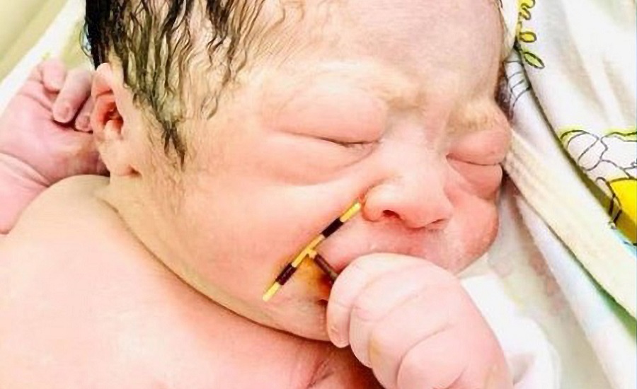تولد یک نوزاد به همراه آی‌یودی عمل نکرده مادرش