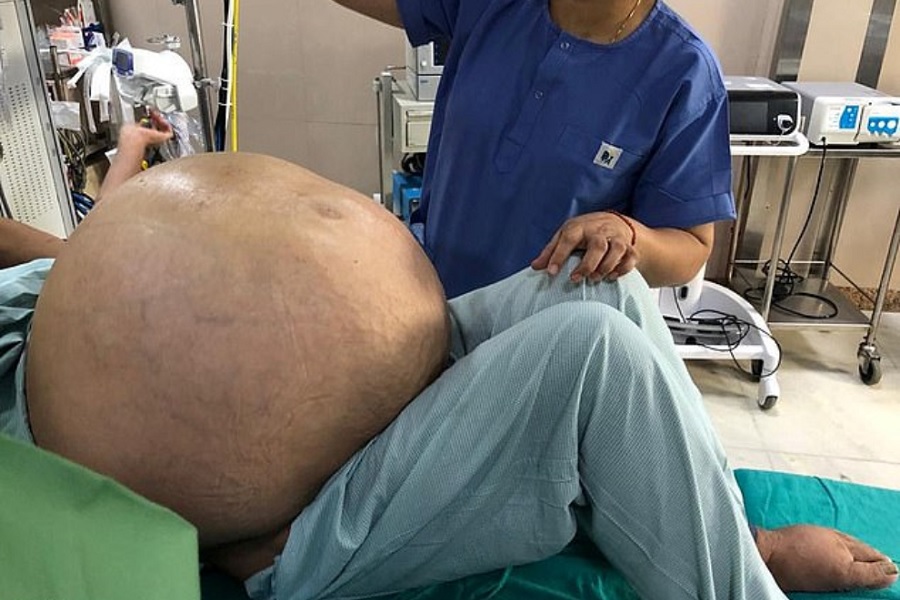 عمل موفقیت آمیز بیرون آوردن بزرگ ترین تومور تخمدانی دنیا به وزن ۵۱ کیلوگرم