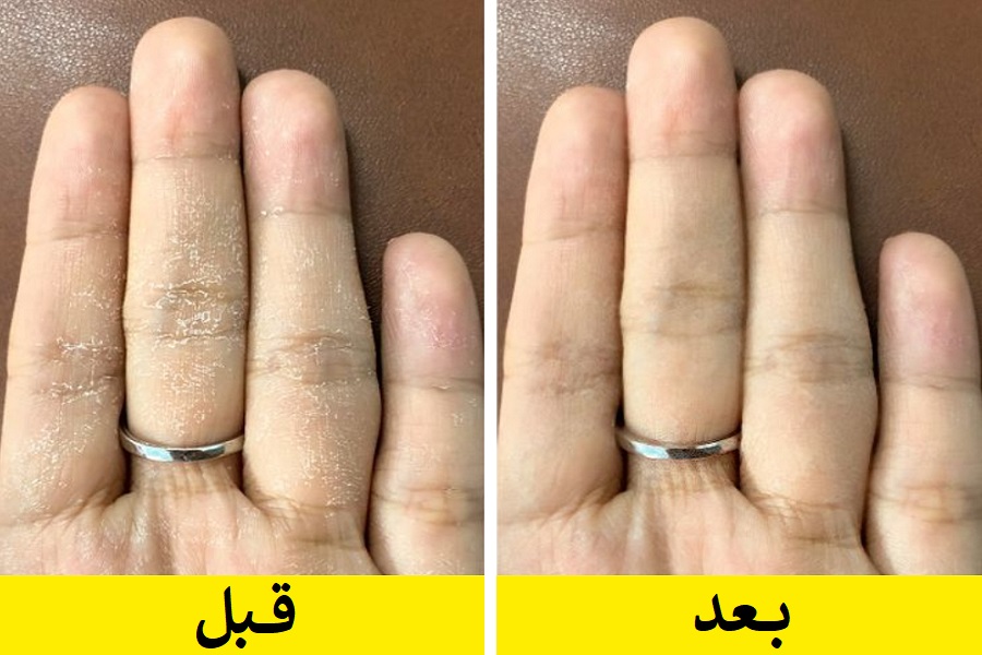 چند ترفند ساده و طبیعی برای رفع خشکی دست ها