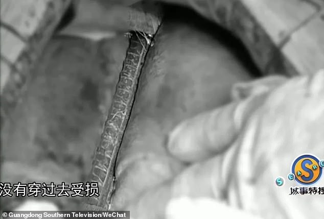 فرو رفتن میله فولادی 80 سانتیمتری در بدن زن چینی