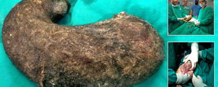 بیرون کشیدن توپ مویی ۷ کیلوگرمی از معده دختر مبتلا به «سندروم راپونزل» + ویدیو