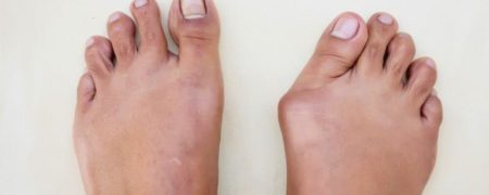 بونیون یا انحراف شست پا چگونه درمان می شود؟