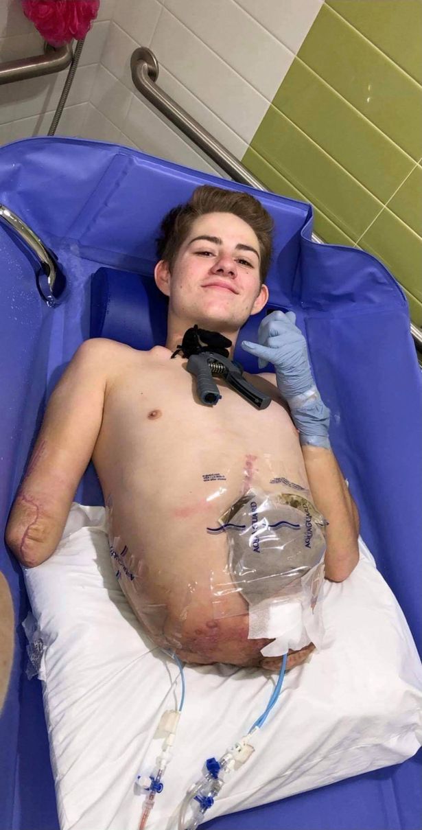 نوجوانی که از یک حادثه هولناک با لیفتراک جان سالم به در برده بود بعد از قطع شدن نیمه پایینی بدنش و علیرغم تمامی پیش بینی ها، زنده ماند.