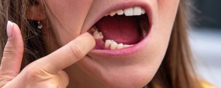 افتادن ناگهانی دندان ها عارضه جانبی جدید کرونا