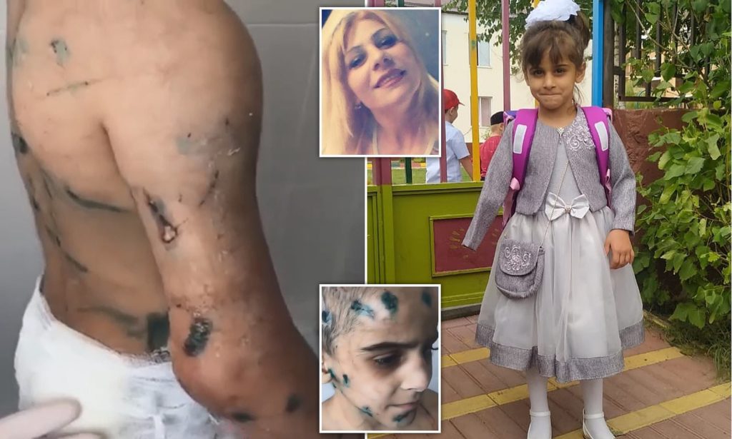 شکنجه‌های هولناک عمه شیطان‌صفت باعث قطع شدن دست دختر ۷ ساله شد + ویدیو