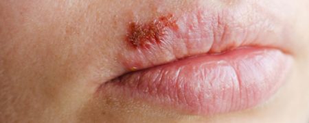 راهکارهایی ساده برای درمان سریع تبخال