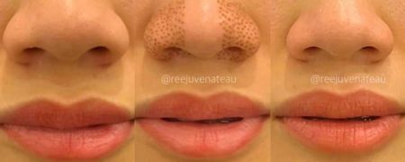 کوچک کردن بینی بدون جراحی با روش پلاسما فیبروبلاست