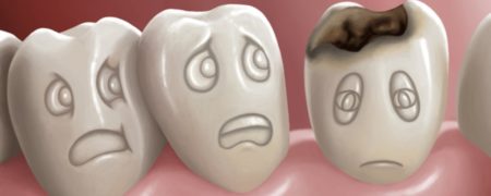 اگر پوسیدگی دندان را درمان نکنیم دقیقاً چه اتفاقی می افتد؟