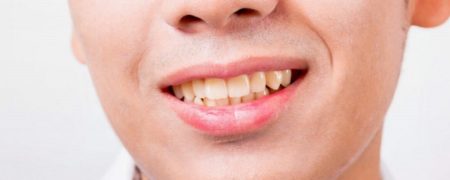 این خوراکی ها دندان ها را زرد می کنند