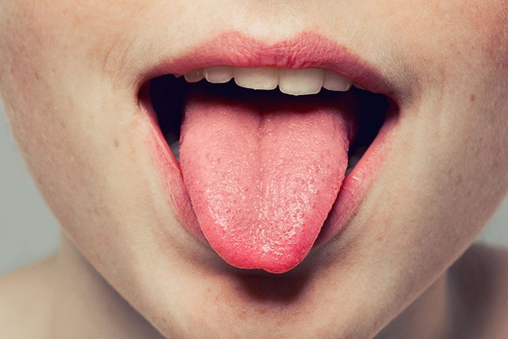 سوختگی زبان را چطور درمان کنیم؟