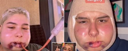 کاربر تیک تاک با پست کردن ویدیوهای درد کشیدن پس از جراحی فک خود معروف شد