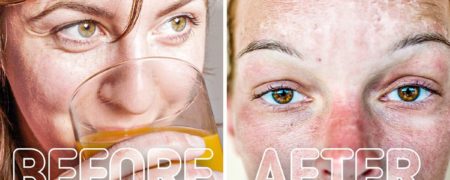 این کارها را بعد از آفتاب سوختگی انجام ندهید