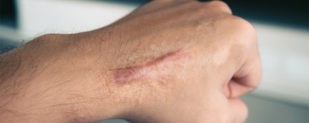 کلوئید چیست و چطور درمان می شود؟