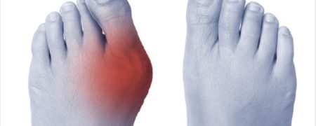 ۸ راه برای تسکین درد انحراف شست پا