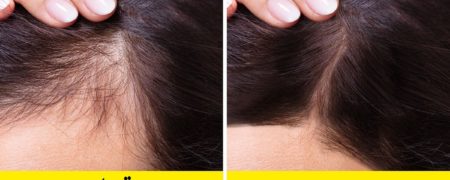 مصرف روزانه گردو چه تأثیری بر پوست دارد؟