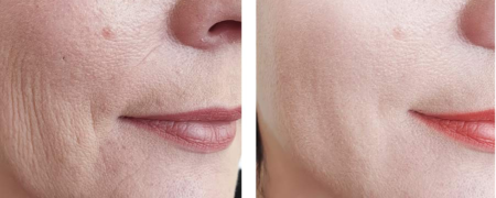 بهترین روش‌های جوانسازی پوست