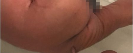 به دنیا آمدن کودکی با دم ۱۲ سانتی متری در برزیل